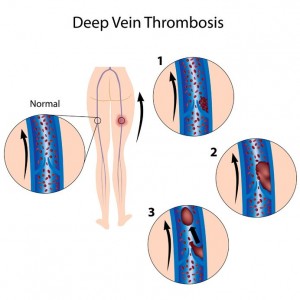 Deep Vein Thrombosis Treatment At Arizona Vein   Vascular Center
