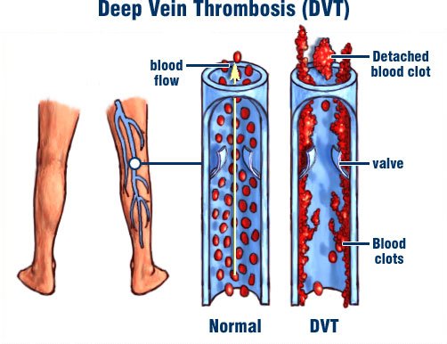 Diagram Showing Formation Of Clots In Leg Vein