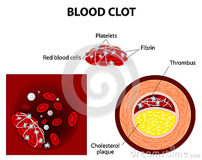 Thrombus  Clots Obstruct Blood Flow Through Healthy Blood Vessels