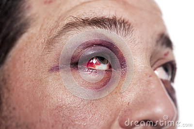 Eye Injury Male With Black Eye Isolated On White  Man After Accident