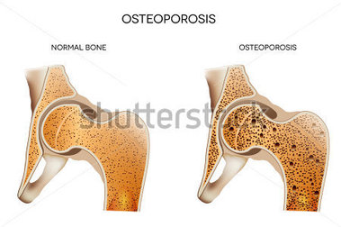     Bone Osteoporosis Osteoporosis May Leads To Bone Fracture 135507926