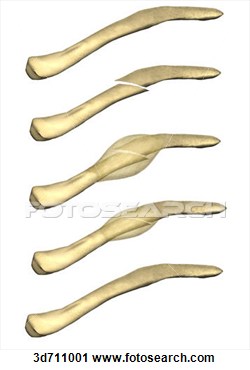 Clipart   A Part Of The Bone Fracture Healing Process   Fotosearch    