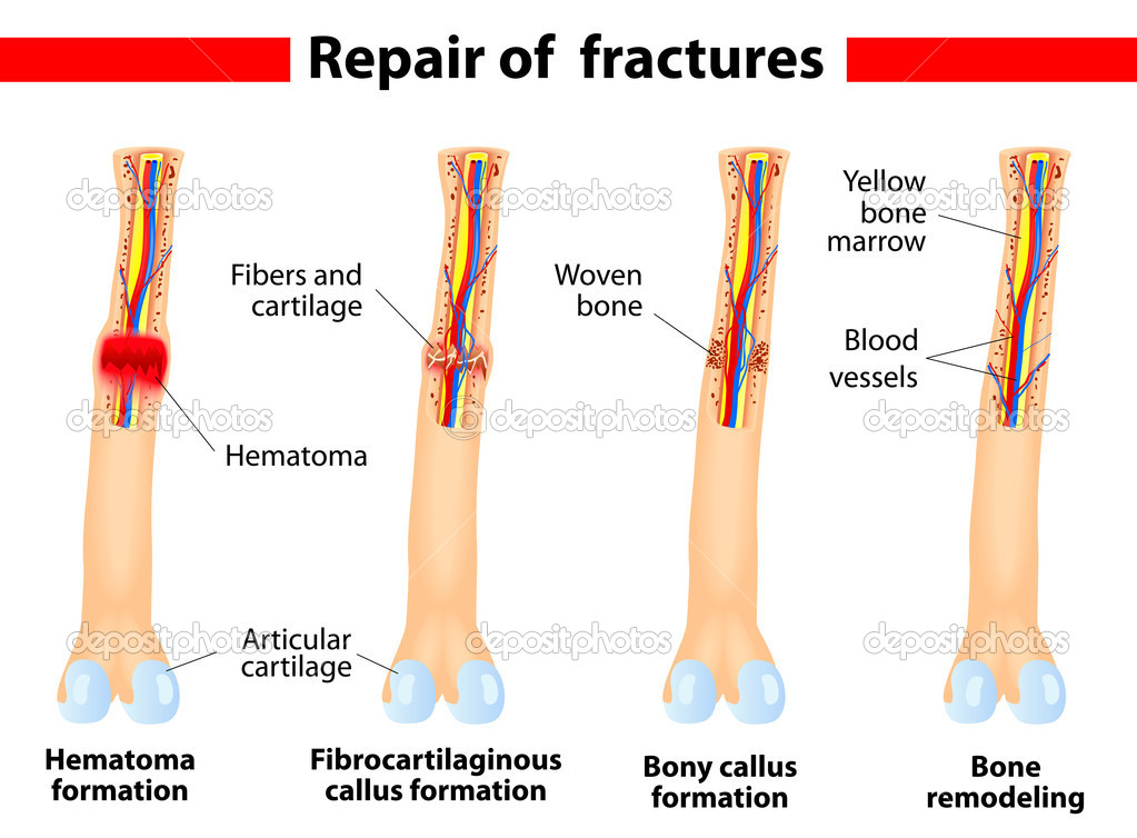 Fracture Osseuse Processus De Gu Rison   Image Vectorielle    
