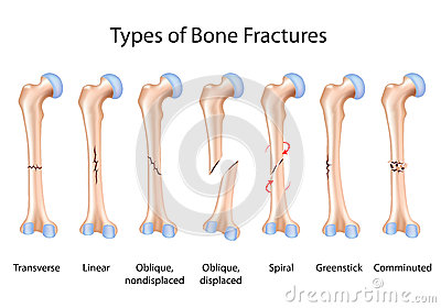 Fractured Bone Clipart Types Of Bone Fractures