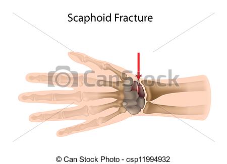 Scaphoid Bone Fracture Most Common Of Carpal Bone Fracture A Sport    
