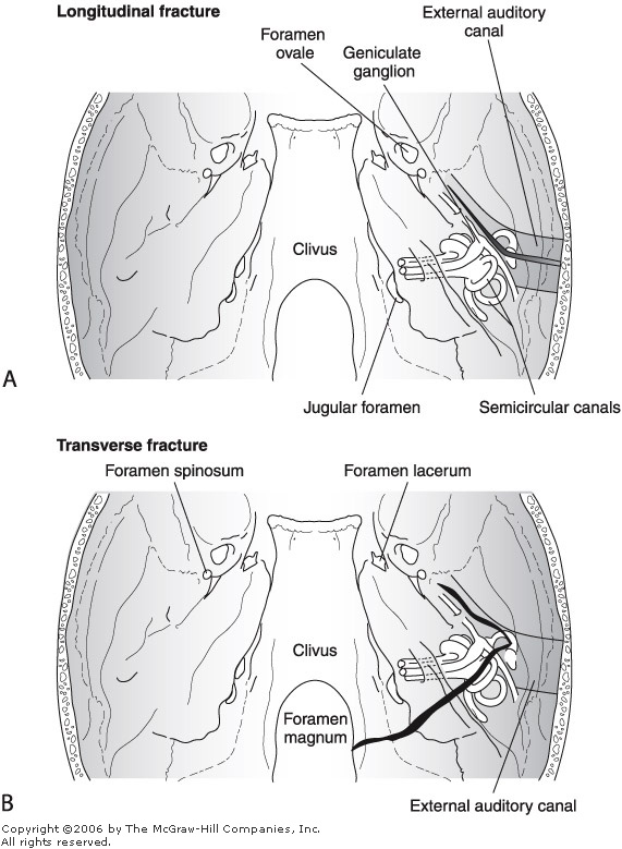 Temporal Bone At Birth Pictures