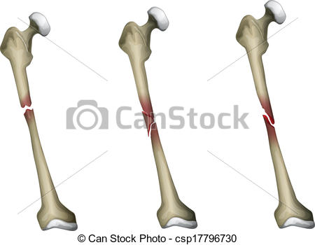 Vectors Of Bone Fracture   Three Types Of Bone Fracture In The Femur    