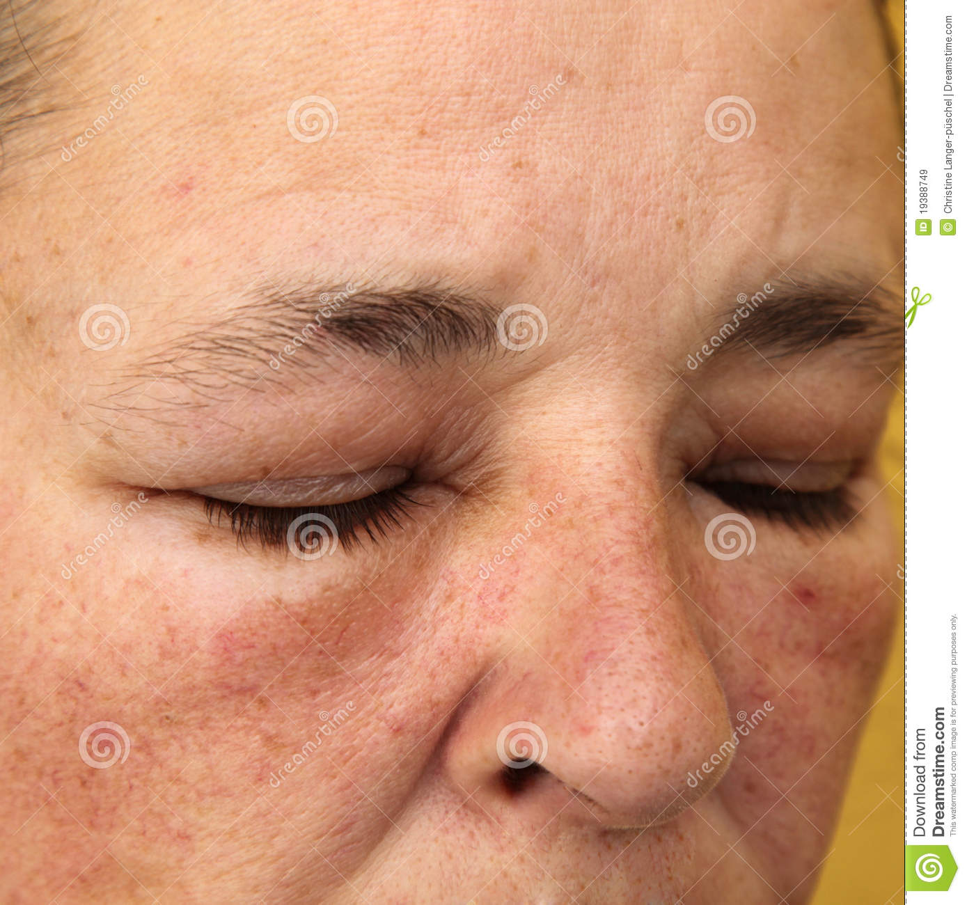 Swollen Eyes And Face For Allergy   Close Up   Square