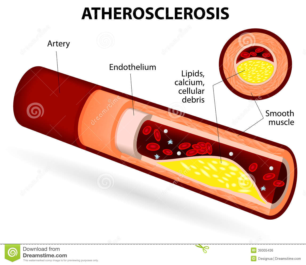 Calcium Fat And Cholesterol  It Reduces The Elasticity Of The Artery