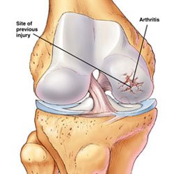 Arthritis Knee Brace   Learn If A Brace Can Reduce Knee Joint Pain
