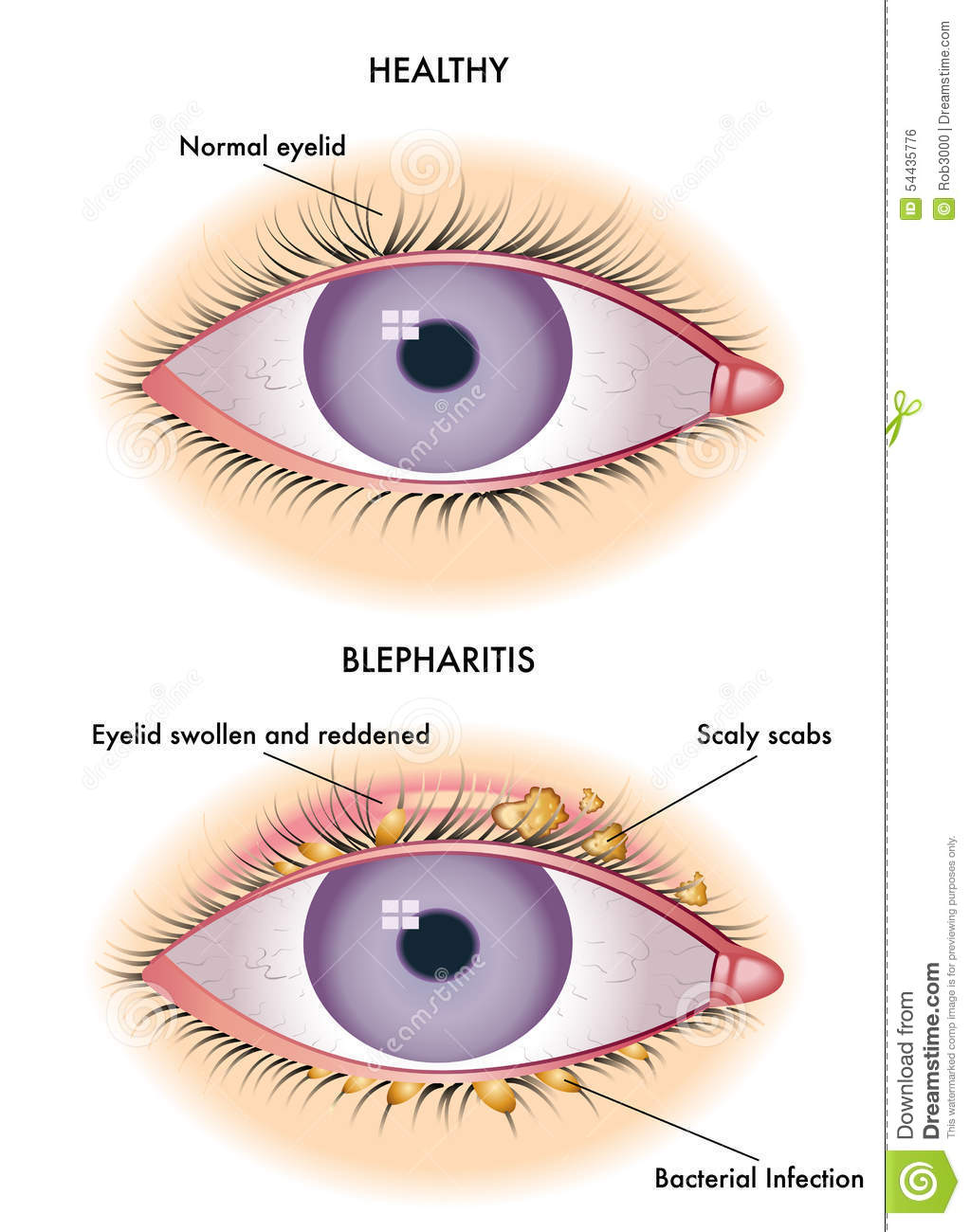 Medical Illustration Of The Symptoms Of Blepharitis