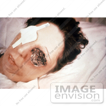     On The 25th Day Of An Anthrax Infection Involving Her Eye By Jvpd