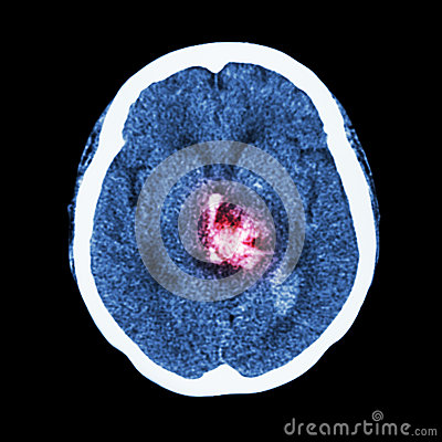 Ct Scan Of Brain   Show Hemorrhagic Stroke