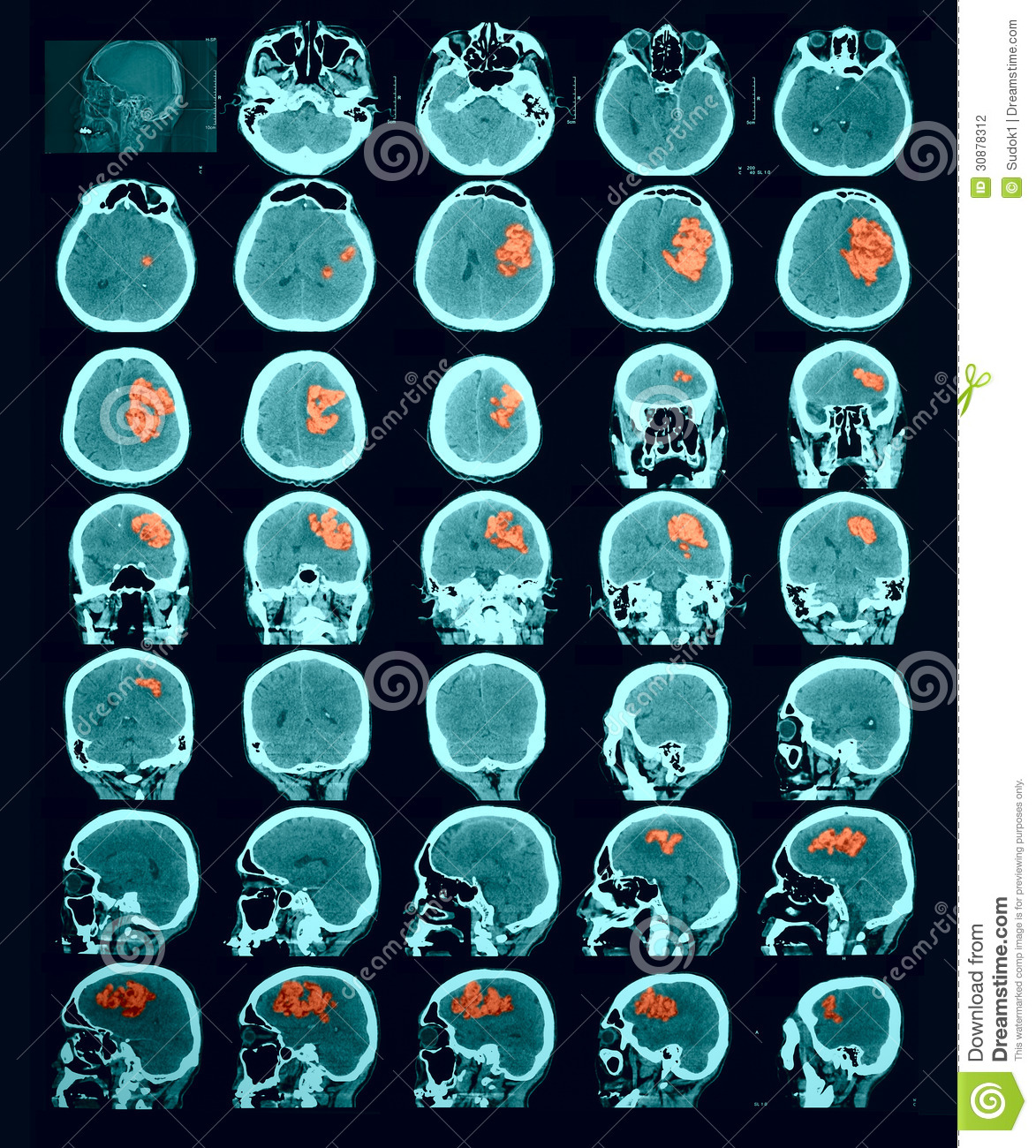 Ct Scan Of The Brain  Hemorrhagic Stroke  Red Us To Identify The