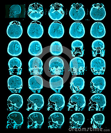 Ct Scan Of The Brain  Royalty Free Stock Photos   Image  31085088