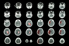 Hemorrhagic Stroke And Ischemic Stroke   Ct Scan Of Brain