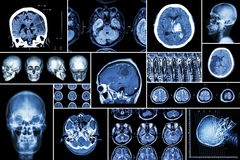 Hemorrhagic Stroke  Brain Tumor  Disc Herniation With Spinal Cord
