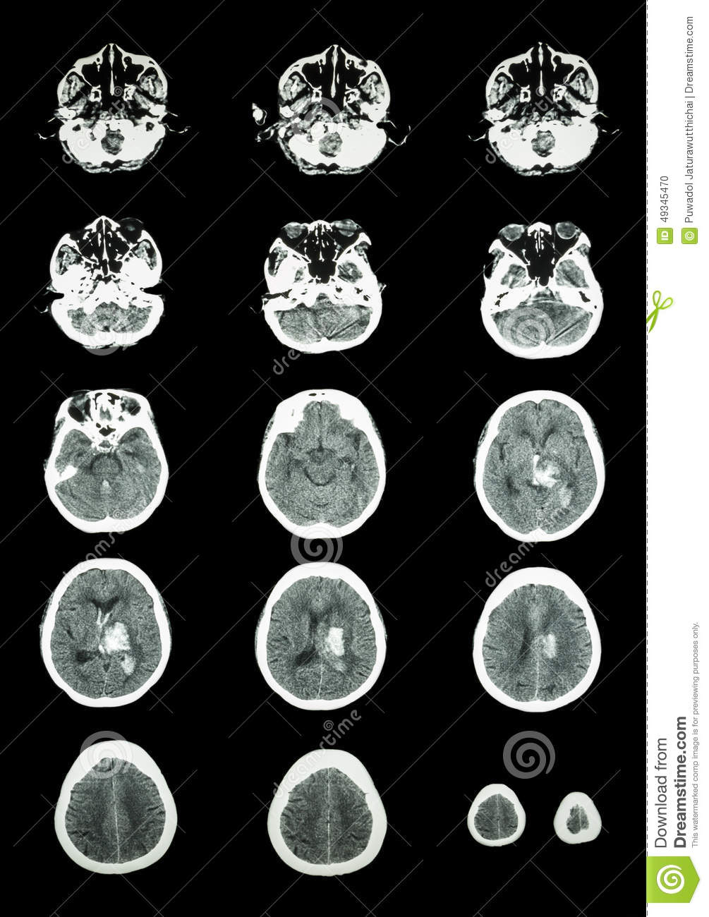Hemorrhagic Stroke   Ct Scan  Computed Tomography  Of Brain   C