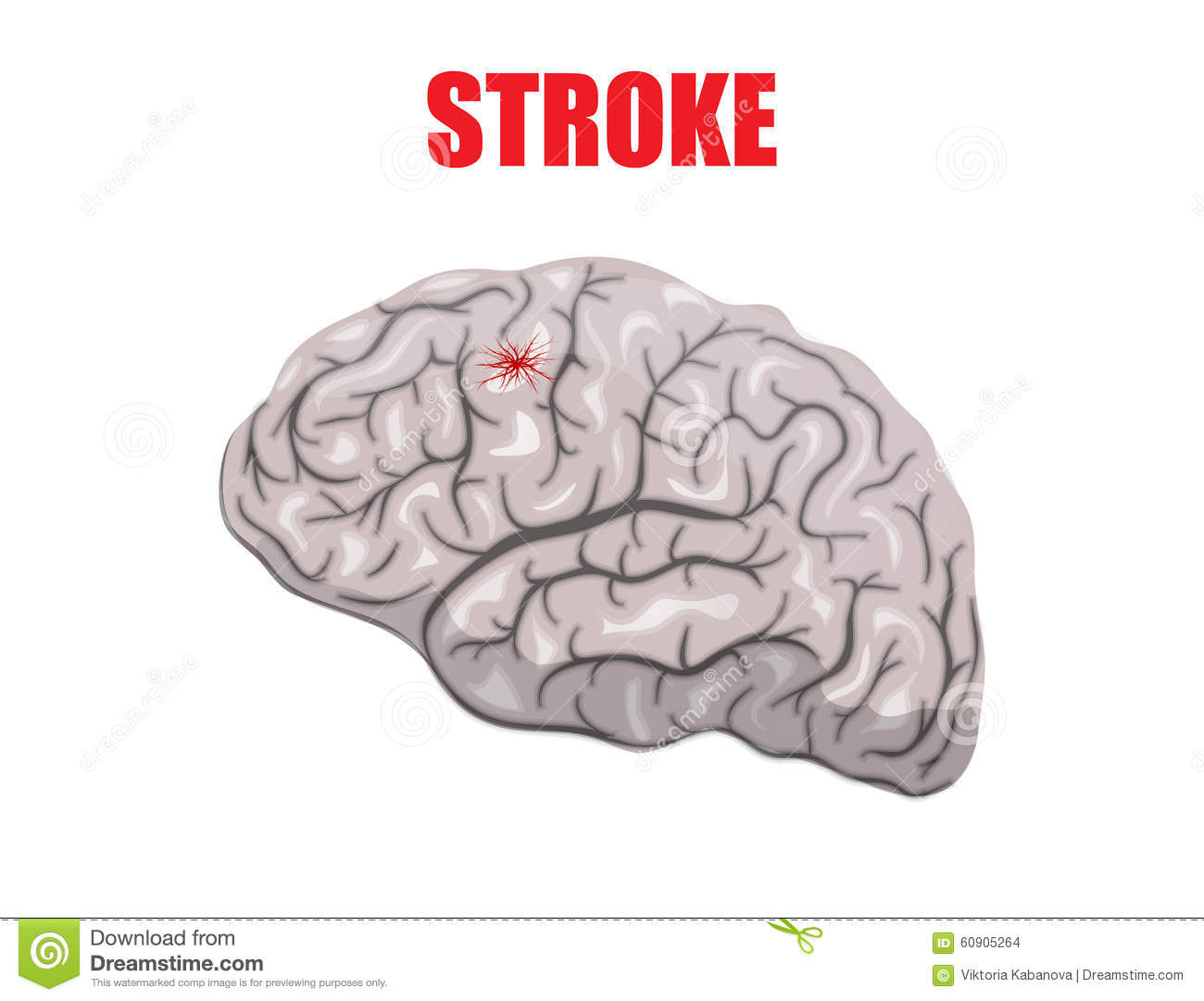 Illustration Of A Hemorrhagic Stroke