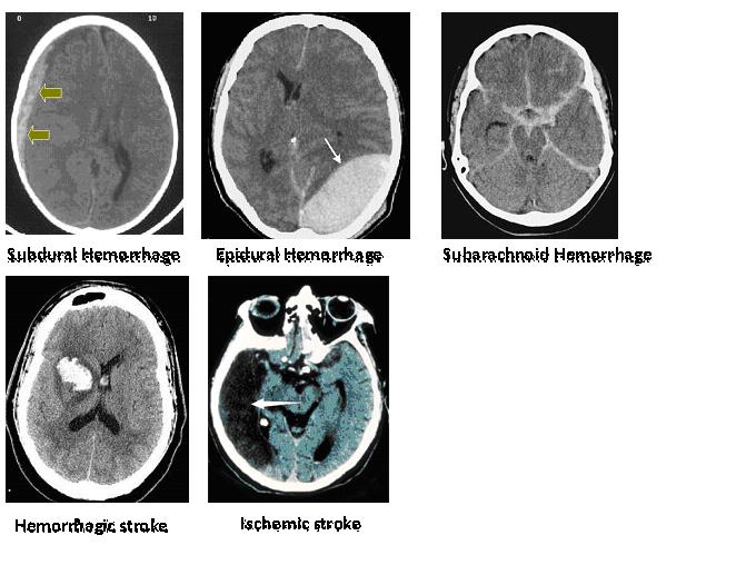 Ischemic Stroke Vs Hemorrhagic Stroke Ischemic Stroke