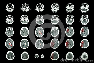 Stock Photo  Hemorrhagic Stroke And Ischemic Stroke   Ct Scan Of Brain