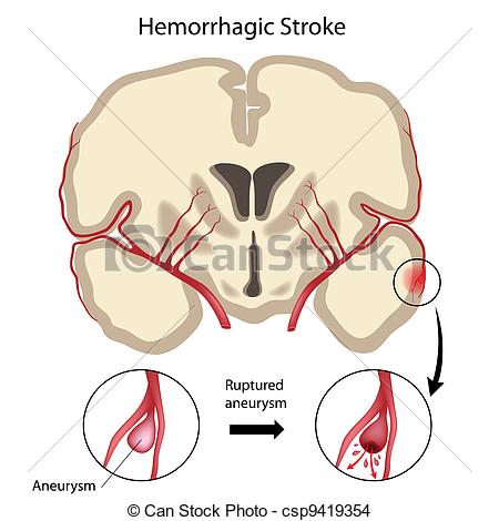 Vector   Brain Hemorrhagic Stroke Eps10   Stock Illustration Royalty