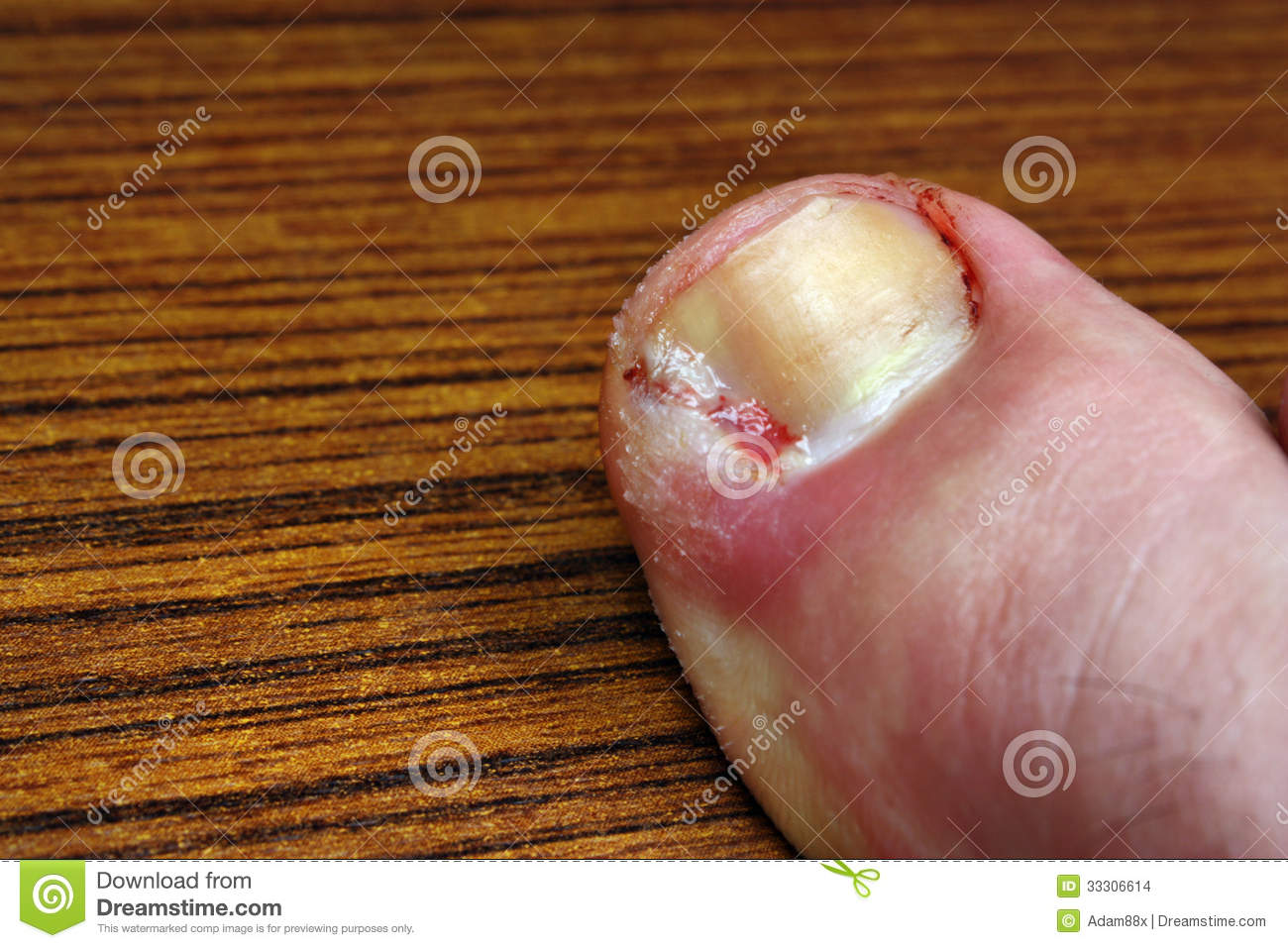 Ingrown Toenail Disease Blood Wound Infection Bacteria Finger Skin