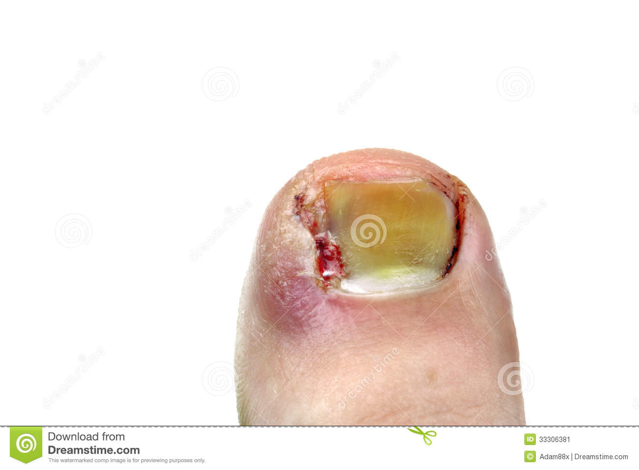 Ingrown Toenail Disease Blood Wound Infection Bacteria Finger Skin