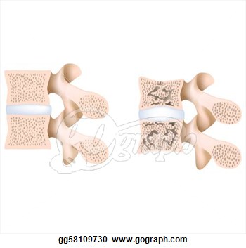 Clipart   Lumbar Spine With And Without Osteoporosis Eps8  Stock
