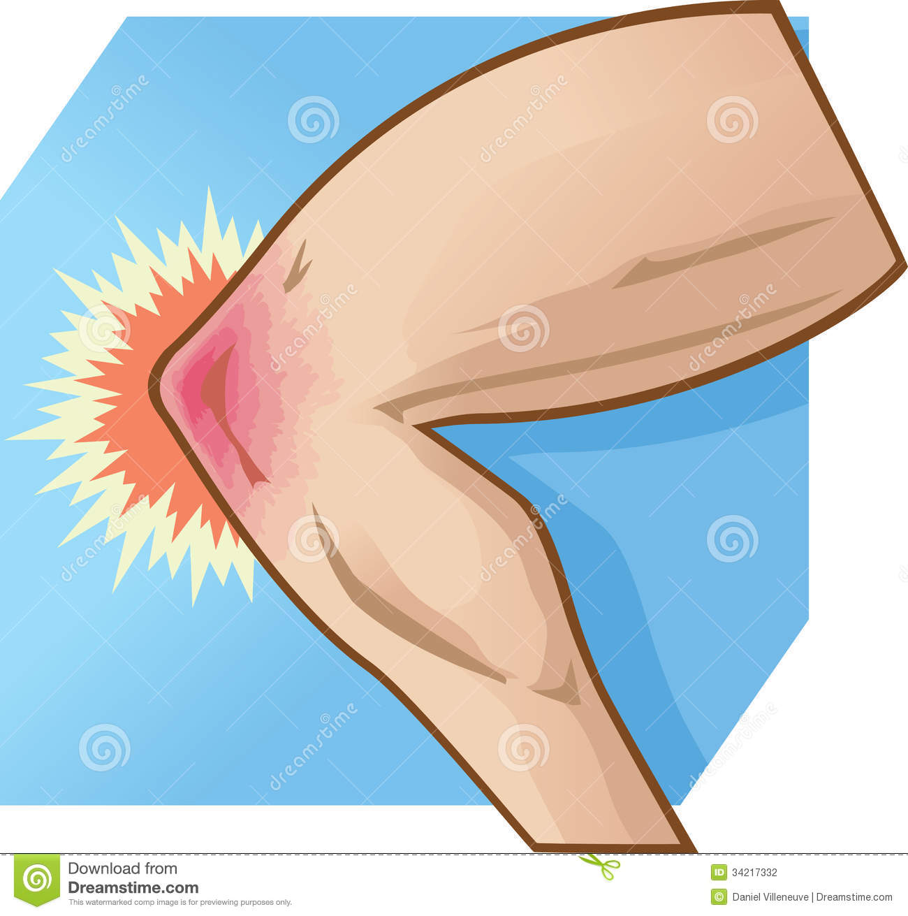 Knee Injury Clipart Knee Pain Illustration Stock Photography   Image