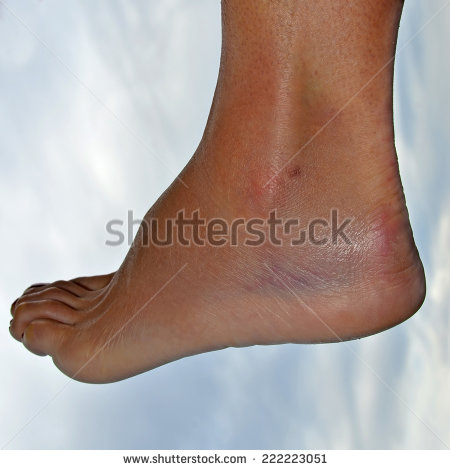 Ankle Swelling