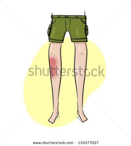 Bruised Leg Illustration  Injured Leg Drawing  Front View Of A Bruised