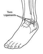     Clinics   Orthopaedics Hospital   Ankle Injury Sign   Symptoms