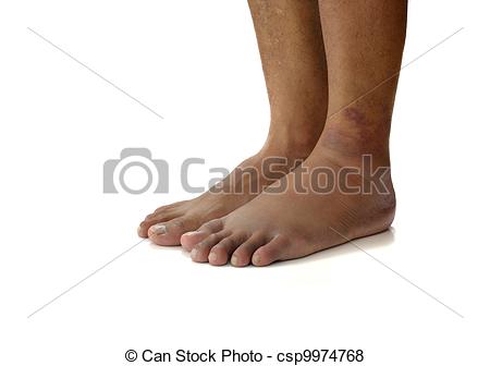 Pictures Of Ankle Sprain   Left Ankle Sprain Swelling From Trauma On    