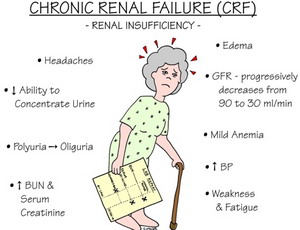 Kidney Failure Chronic  Renal Failure Chronic  End Stage Renal    