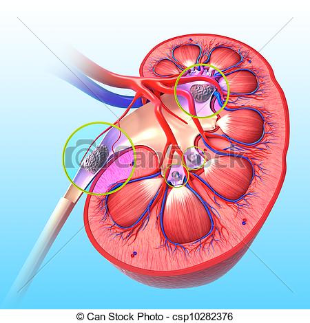 Kidney Failure Clipart Stock Illustration   Kidney