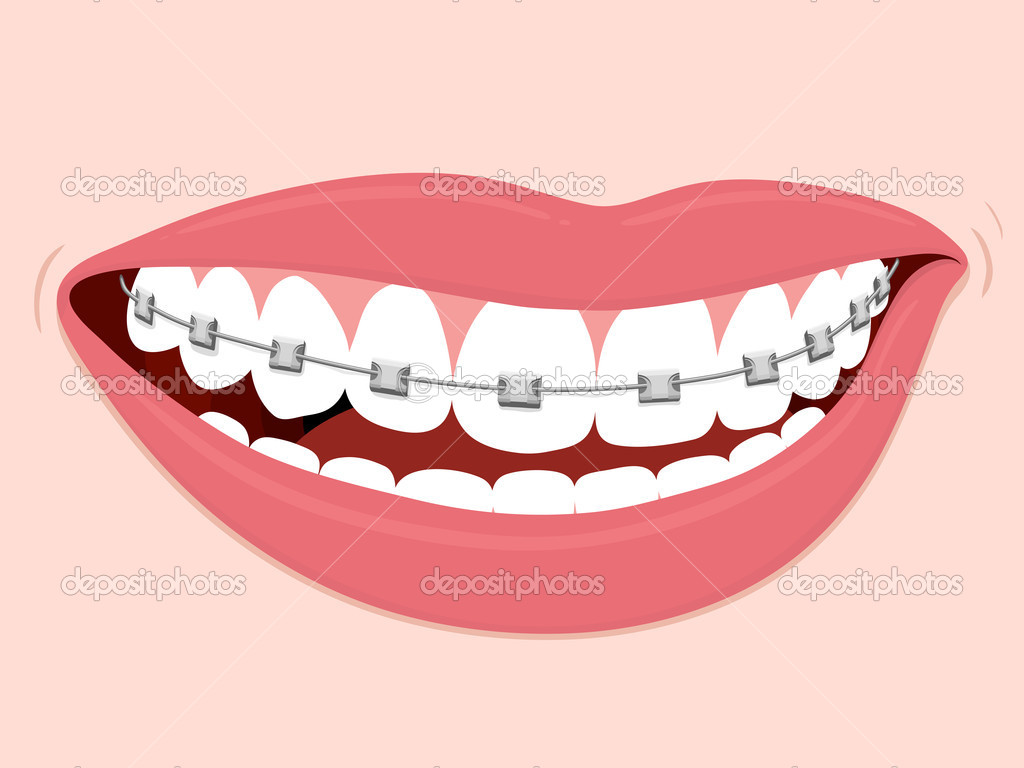 Braces Corrective Orthodontics   Stock Vector   A  N  7913333