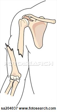 Open  Compound  Fracture Of The Humerus  Sa204037   Search Eps Clipart