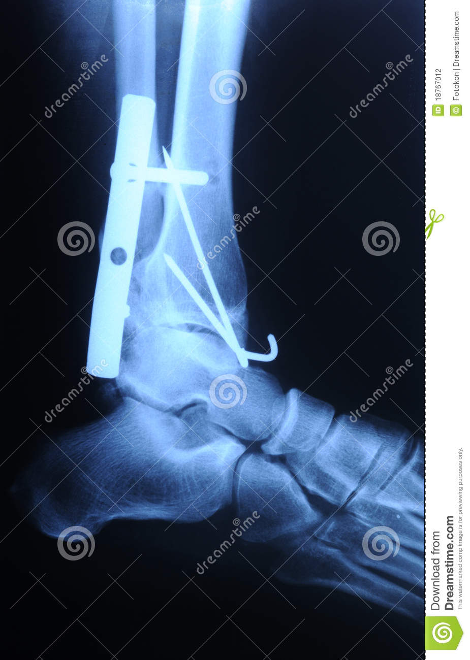 Radiograph Of Human Fracture Ankle Stock Photography   Image  18767012