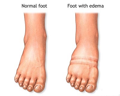 Causes Of Swollen Foot  Ankle Edema And Pitting   National Health News