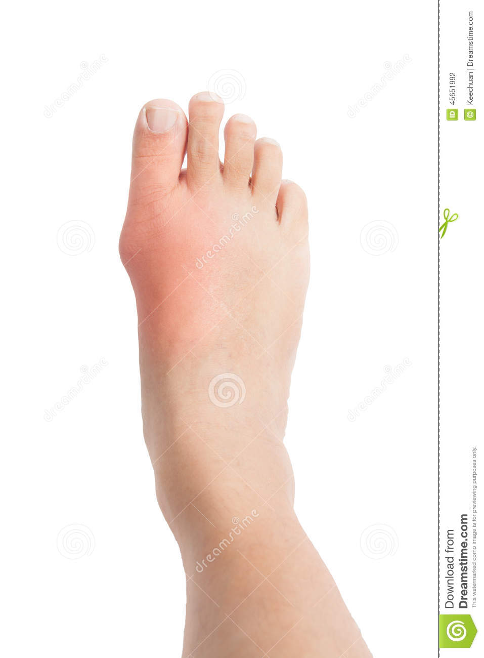 Swollen Foot With Gout Inflammation Stock Photo   Image  45651992