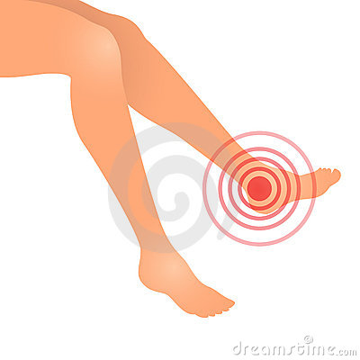 Vector Illustration Of Woman Feet Swollen Or Feet Pain
