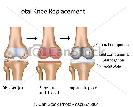 Total Knee Replacement Surgery Total Knee Repl