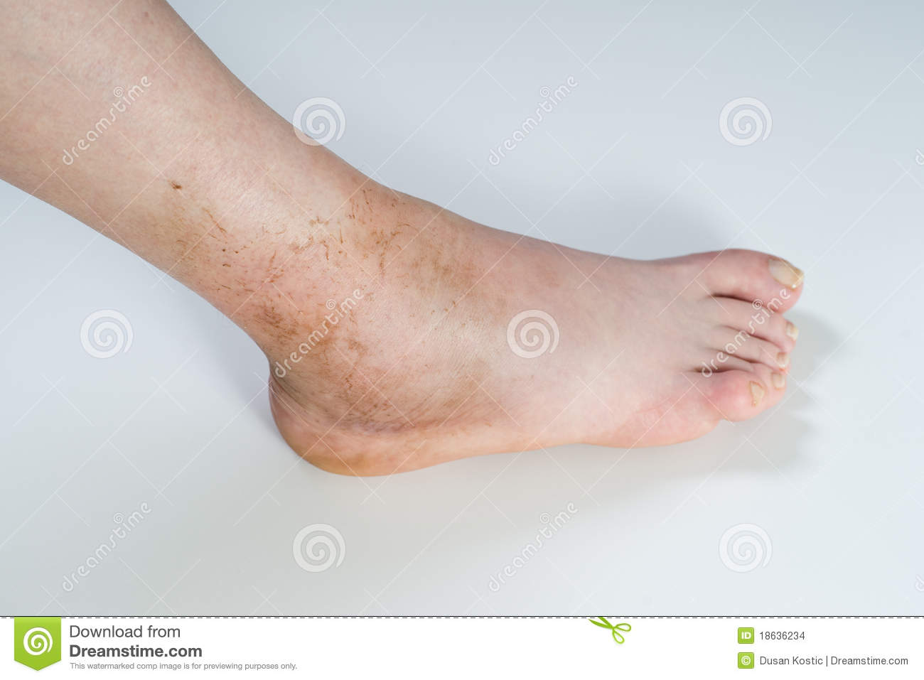 Ankle Sprain Stock Images   Image  18636234