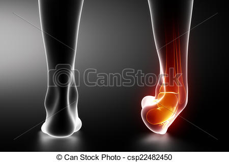 Of Sprained Ankle Black X Ray Csp22482450   Search Clipart