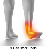 Sprained Ankle On White Clip Art