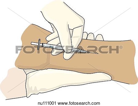 Gloved Hands Inserting Needle Almost Level With The Skin Of The Inside