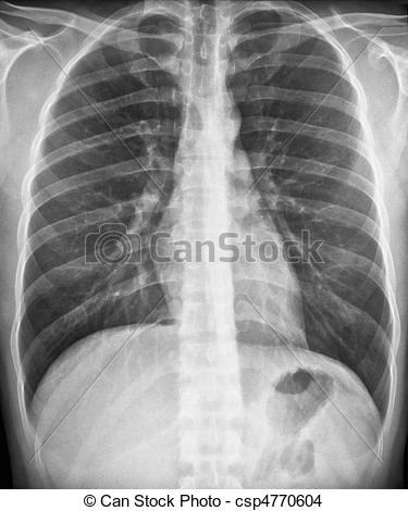 Chest X Ray Pa View   Csp4770604