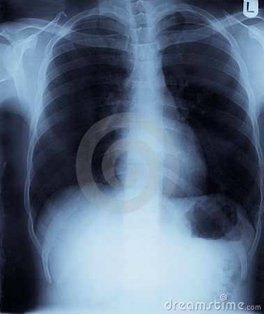 Chest X Ray Royalty Free Stock Image   Image  9196496
