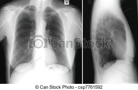 Normal Chest X Ray View Of Mature Women Csp7761592   Search Clipart
